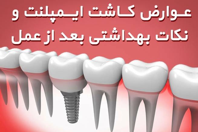 عوارض کاشت ایمپلنت و نکات بهداشتی بعد از عمل